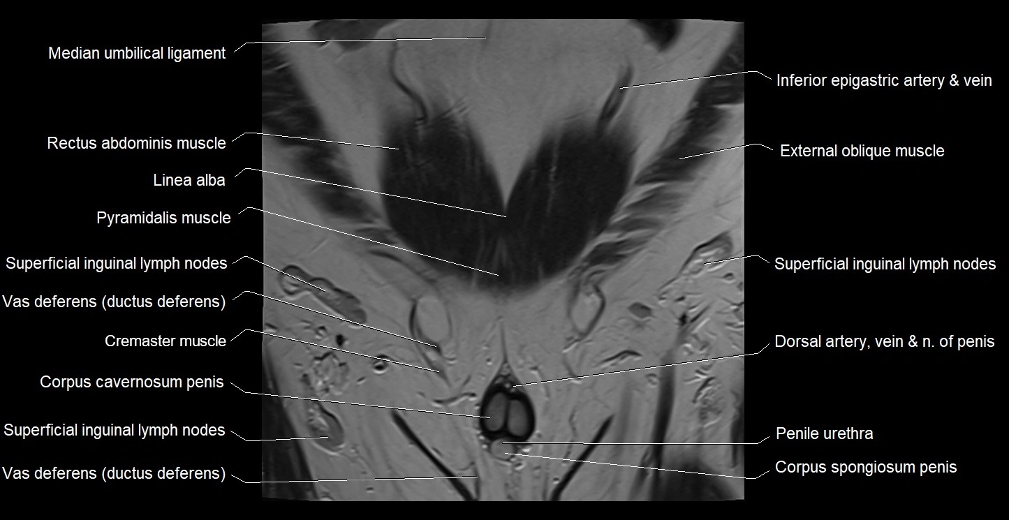 MRI coronal cross sectional anatomy male pelvis image 3.webp